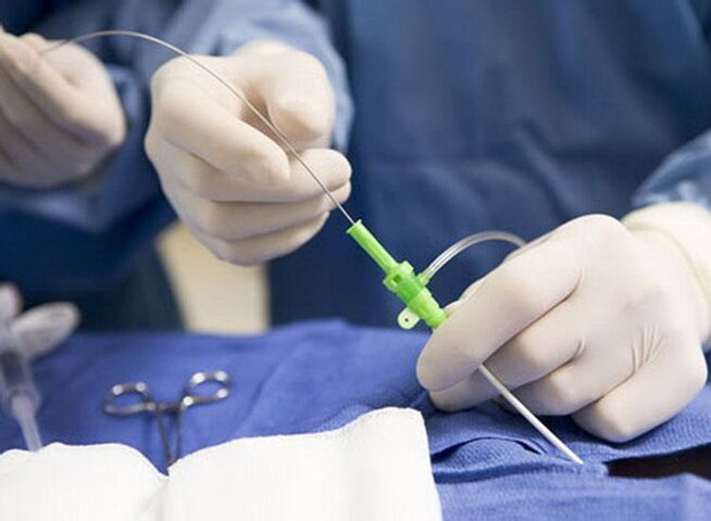 Radiofrequenzablation